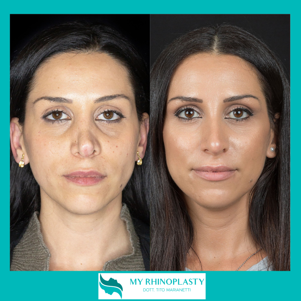 La Rinoplastica Secondaria Quando Rioperarsi My Rhinoplasty