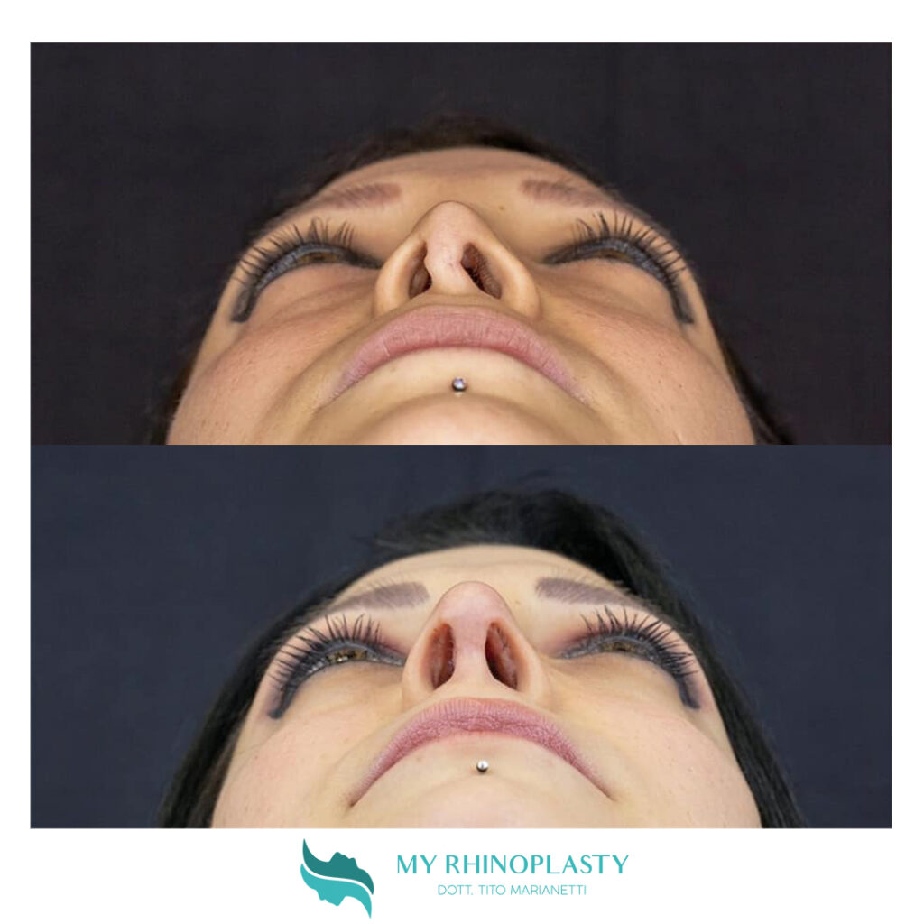 Naso Chiuso 8 Cose Che Devi Sapere My Rhinoplasty