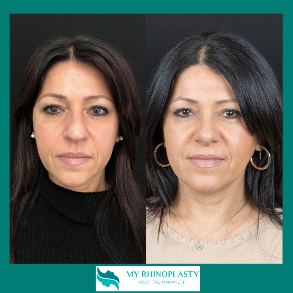 Quanto Costa Rifarsi Il Naso Elementi Importanti My Rhinoplasty