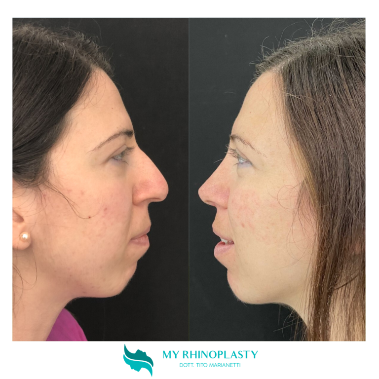 Rifarsi Il Naso Il Periodo Migliore Per La Rinoplastica My Rhinoplasty