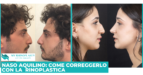 Naso Aquilino Come Correggerlo Con La Rinoplastica My Rhinoplasty