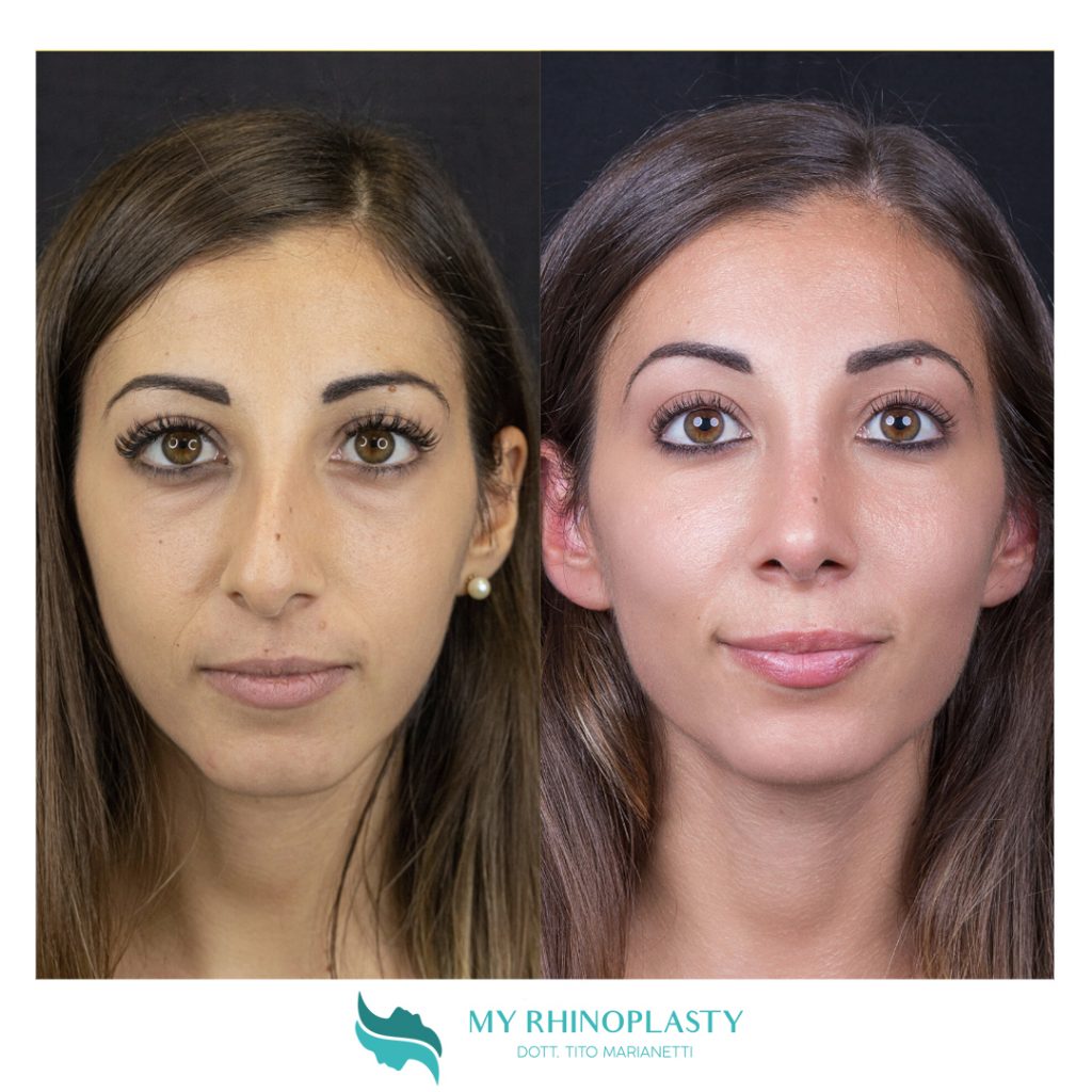 Naso Rifatto Prima E Dopo 6 Casi Di Rinoplastica • My Rhinoplasty