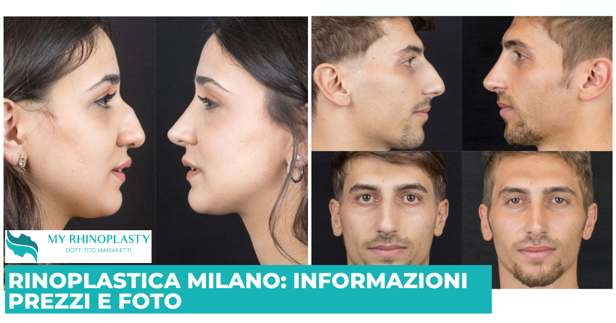 Rinoplastica Milano: informazioni, prezzi e foto